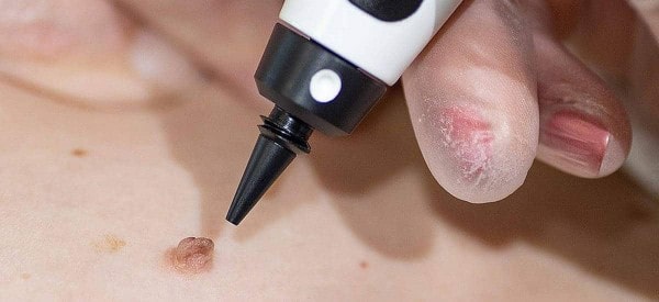 After Skin Tag Removal Bootle