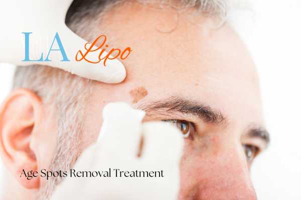 What Are the Most Effective Treatments for Age Spots Bootle?