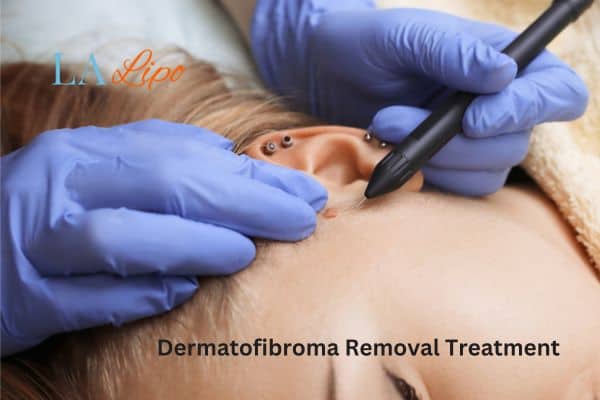 Dermatofibroma Removal Treatment Bootle