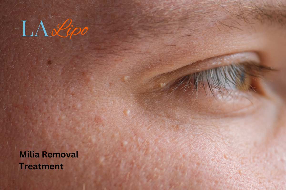 Cryopen Milia Removal: Is It the Easiest and Safest Option Bootle?