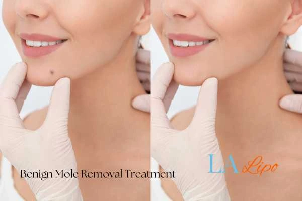 Before-and-after results following benign mole-removal treatment Bootle