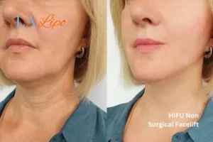 hi-fu for wrinkles Bootle before and after results
