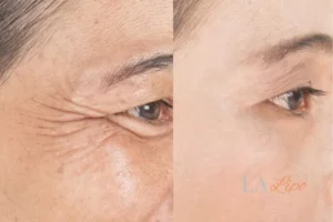 Before and after results of woman - HI-fu wrinkles reduction treatment Bootle