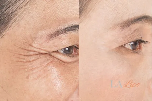 Before and after results of woman - HI-fu wrinkles reduction treatment Bootle