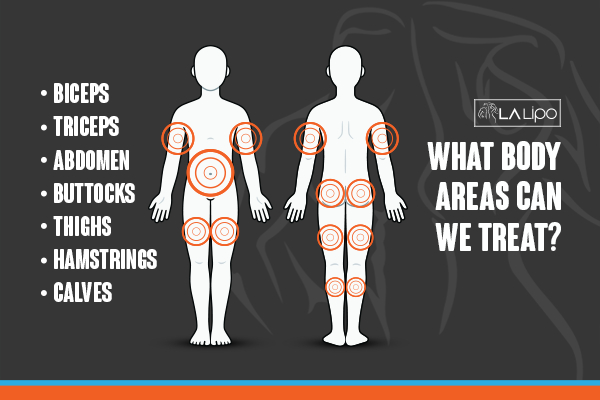 Graphic to show areas you can have LA-EMS Body Sculpting Bootle treatment.