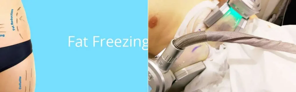 Fat freezing Bootle on multiple areas of the body