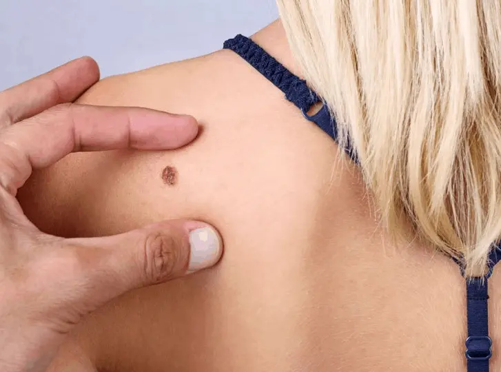 woman having mole removal Bootle consultation before treatment.