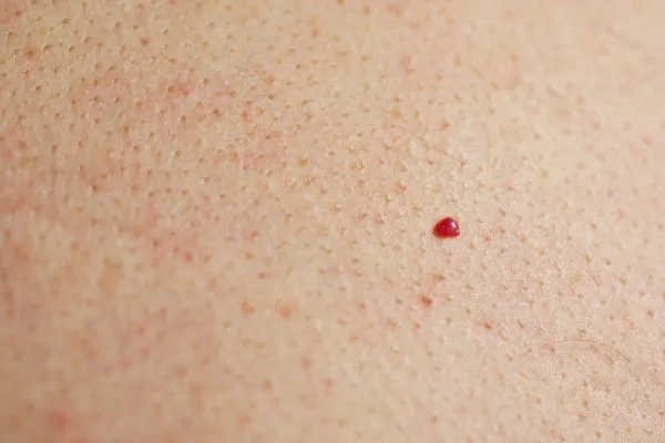 close up of a cherry angioma Bootle