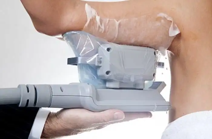 Picture of fat freezing Bootle on the upper arms.