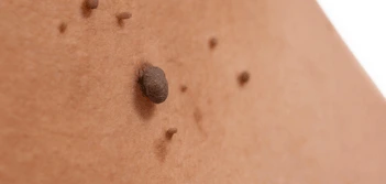 image of a skin tag Bootle