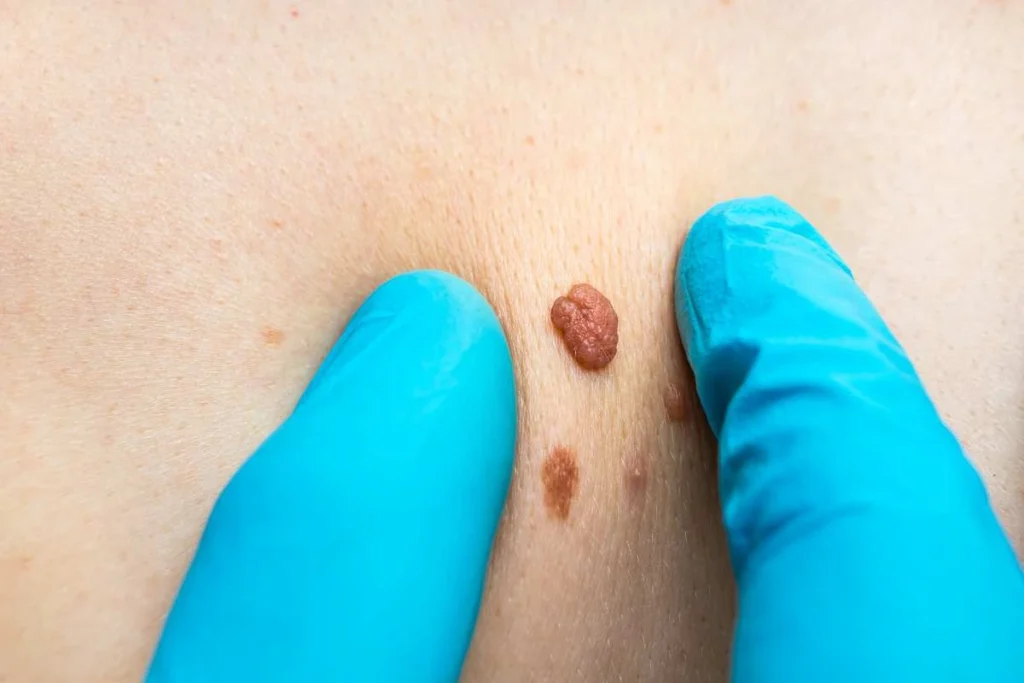 Consultant examining a skin tag Bootle