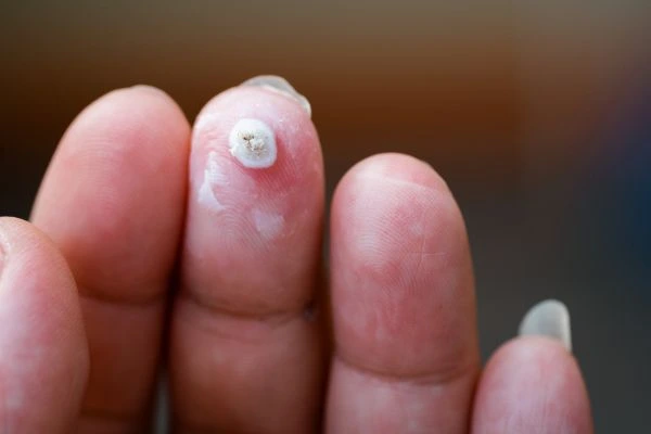 wart on person finger - cryotherapy to treat from LA LIPO Bootle