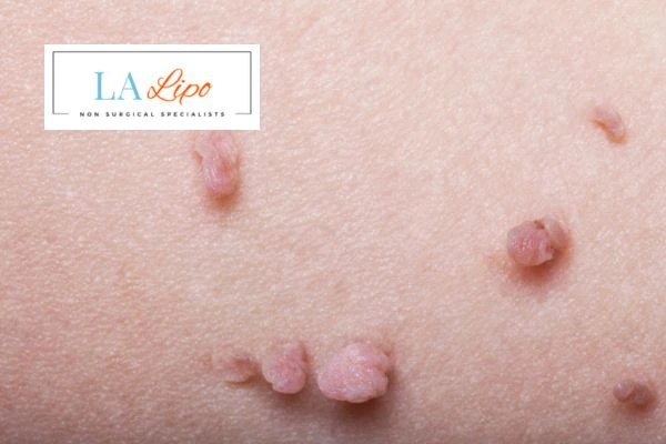 Does cryopen skin tag removal Bootle hurt? Find out now call our team today!