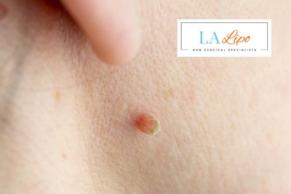 Book skin tag removal Bootle today speak to our team now!