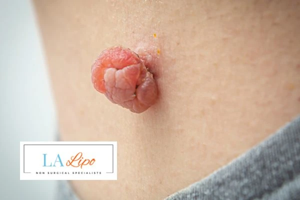 Interested in skin tag removal Bootle? Concerned about the pain? Find out more today!