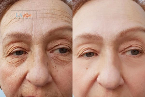 The powerful benefits of Morpheus8 Treatment Bootle - Call Our team today!