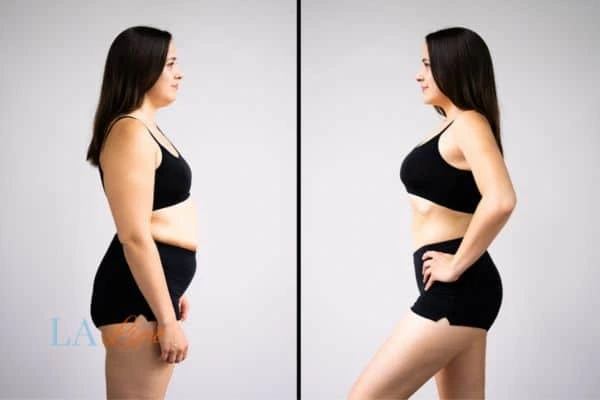 Picture of womans before and after using LA-EMS body sculpting to improve her core strength Bootle