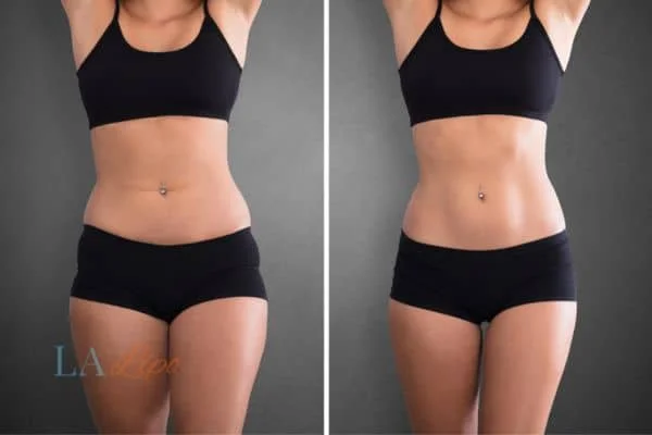 before and after results of non-surgical treatment to help a woman's body image and mental health Bootle