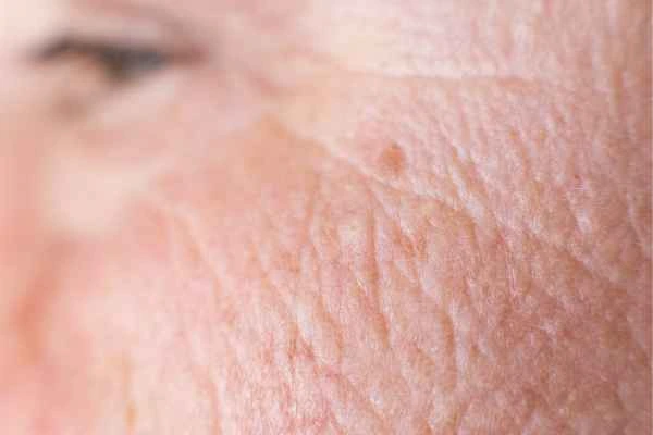 close up picture of a woman's face showing an age spot Bootle