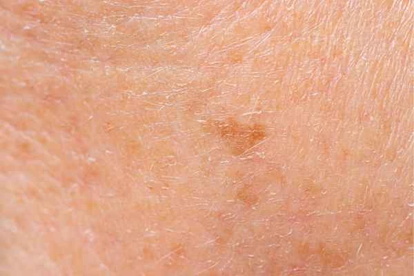 close up picture of age spots Bootle