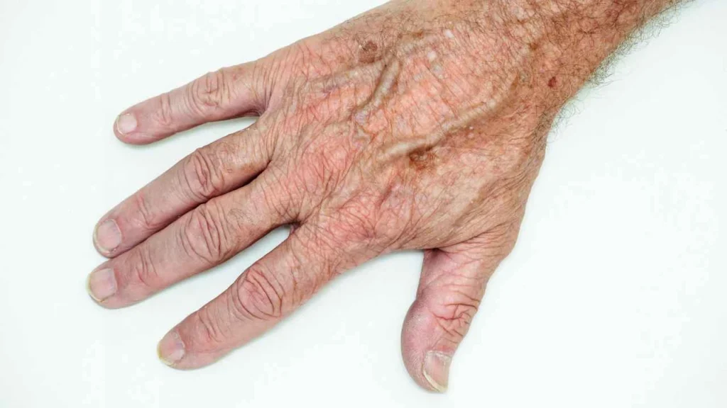 Male hand showing age spot Bootle