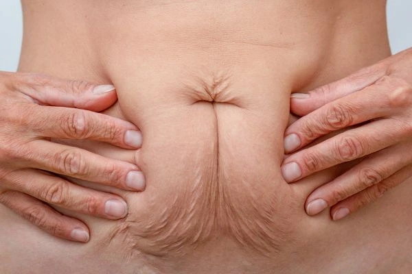 Image of a woman's stomach with loose skin - example of skin tightening Bootle options