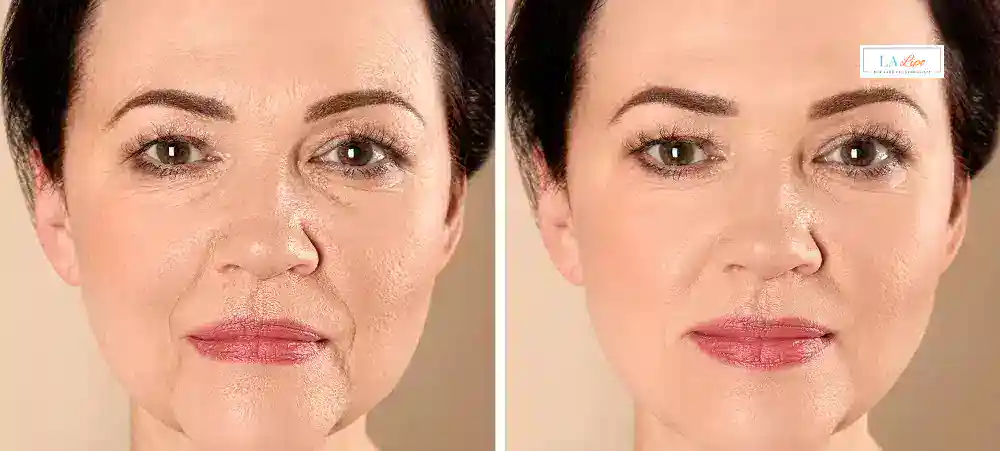 How Long Does It Take to See Results and How Long Do They Last Bootle?