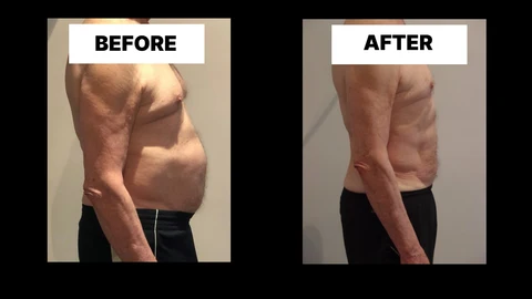 What Symptoms Can Diastasis Recti Cause in Men? Weak Core, Back Pain and Poor Posture Bootle